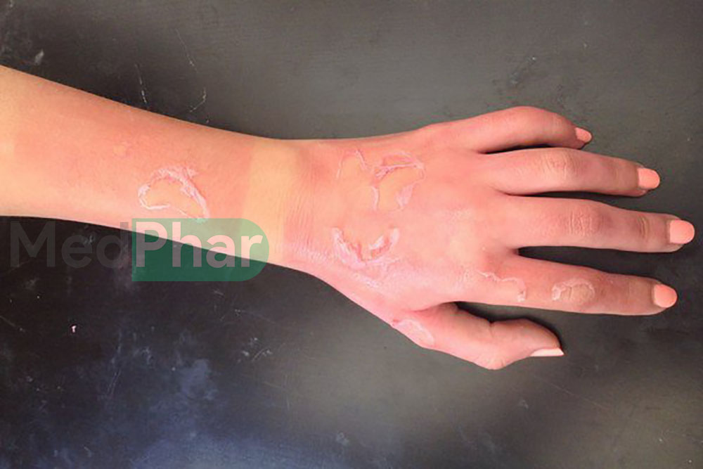 Appolo Wound Gel dùng cho vùng da bị bỏng